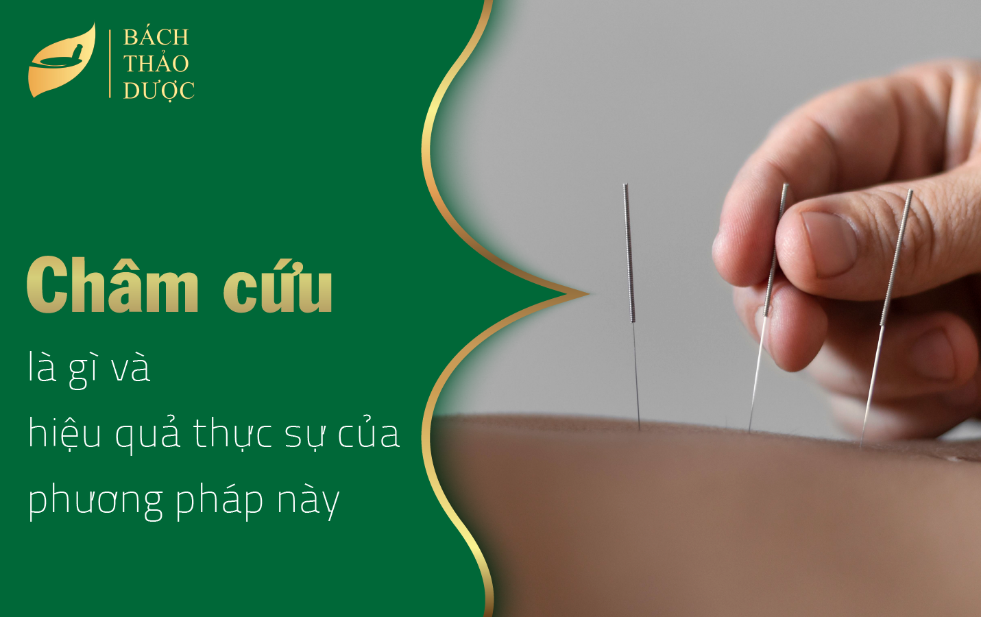 Châm cứu là gì và hiệu quả thực sự của phương pháp này