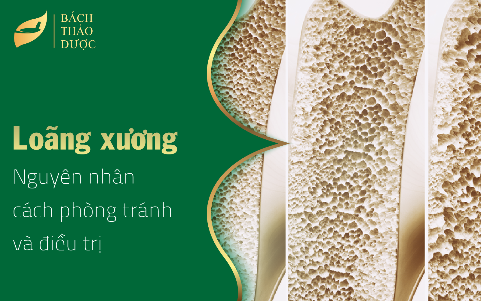 Nguyên nhân, cách phòng tránh và điều trị loãng xương