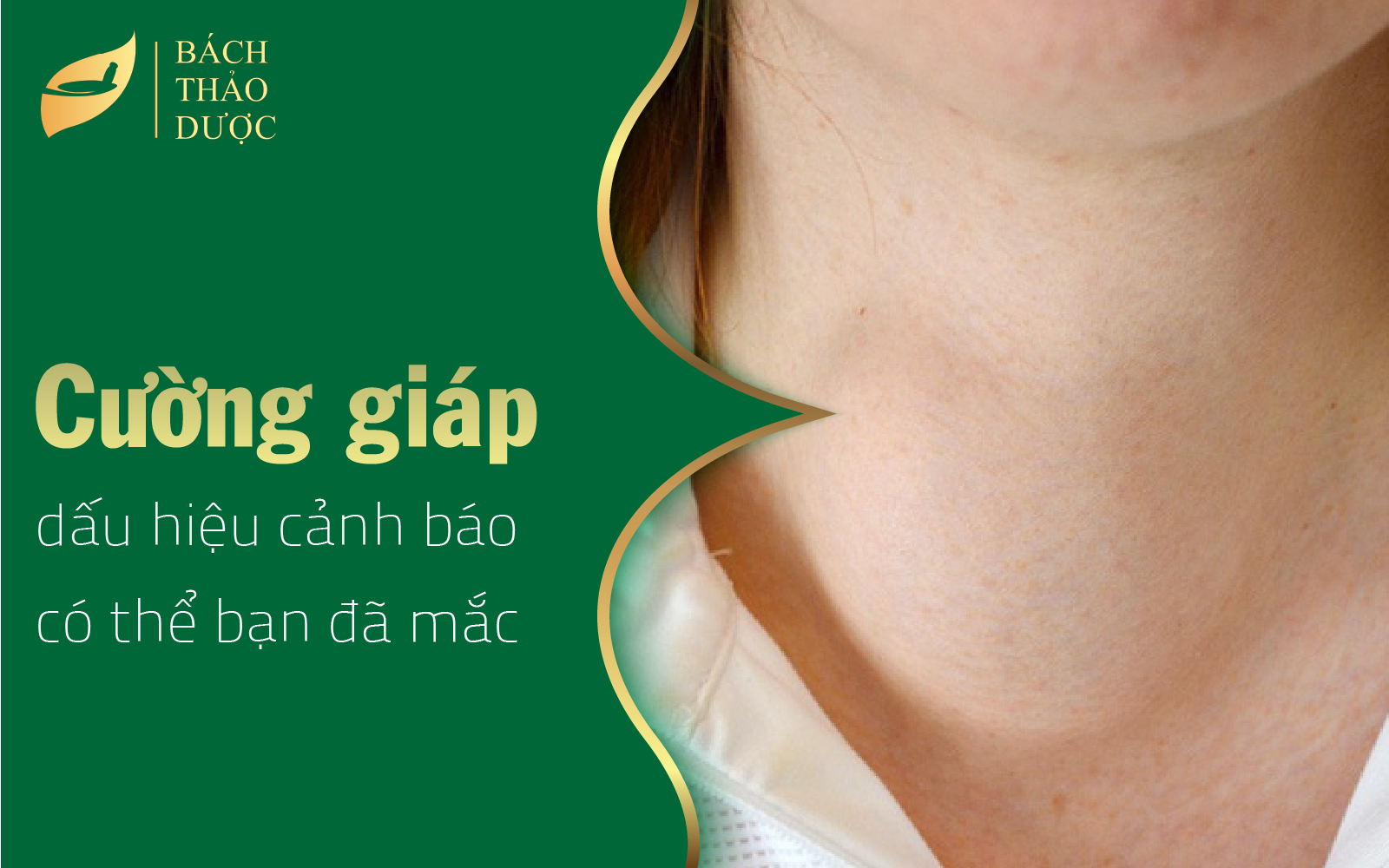 Dấu hiệu cảnh báo có thể bạn đã mắc bệnh cường giáp