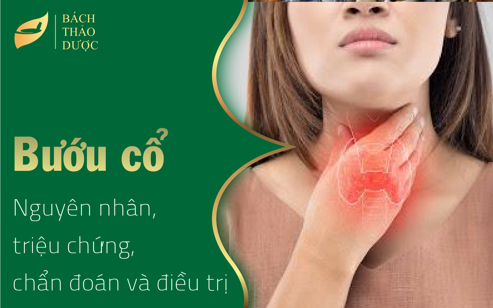 Nguyên nhân, triệu chứng, chẩn đoán và điều trị Bướu cổ