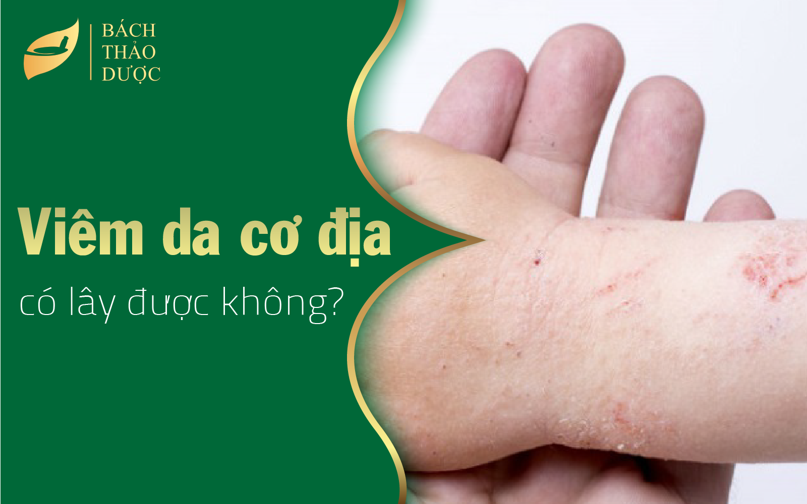 Viêm da cơ địa có lây không?